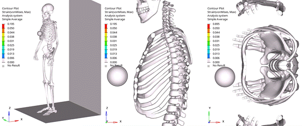 Example of Finite Element Analysis of a Human Body which is hit by a steel ball